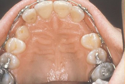 Impacted Teeth | Georgia | South Oral & Maxillofacial Surgery