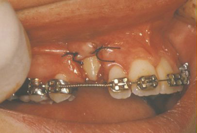 Impacted Teeth | Georgia | South Oral & Maxillofacial Surgery