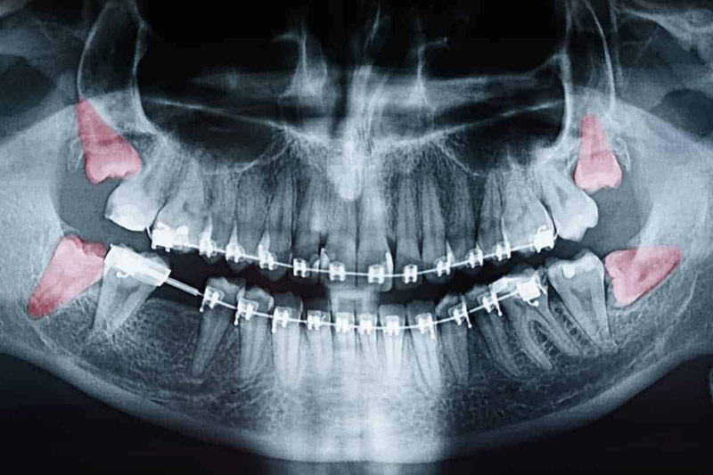 wisdom teeth xray