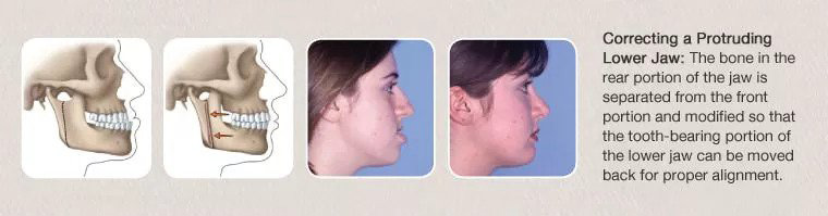 corrective jaw surgery