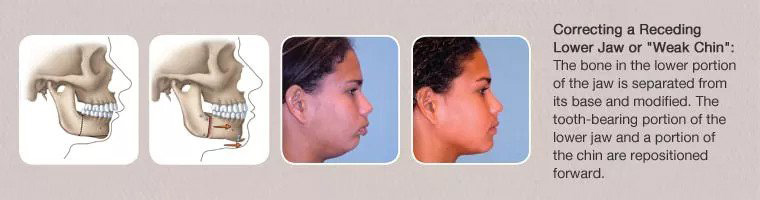 corrective jaw surgery