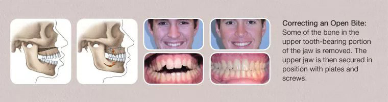 corrective jaw surgery